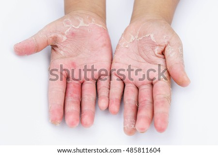 Dry Hands Peel Contact Dermatitis Fungal Stock Photo (Royalty Free ...