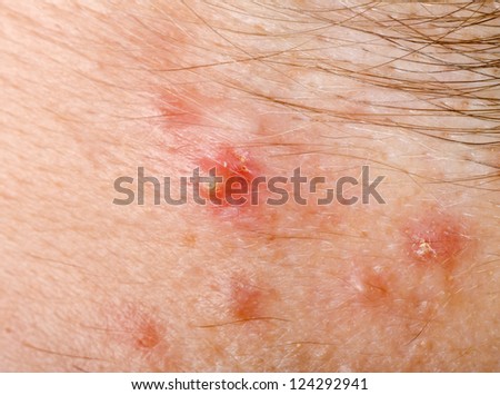 pictures of pimple on human skin macro csp9188528 search stock photos images carbuncle stock images royalty free images vectors pictures of pimple on human skin macro csp9188528 search stock photos images carbuncle stock images royalty free images vectors