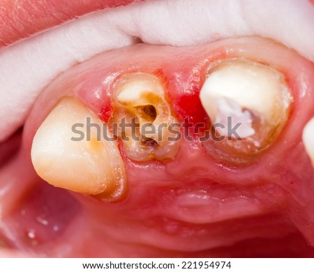 Foto aproximada da reabilitação dentária