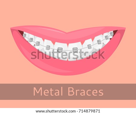 Braces Smile Stock Images, Royalty-Free Images & Vectors | Shutterstock