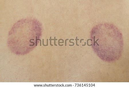 Red Spot Skin Effect On Backside Stock Photo (Royalty Free) 736145104 ...