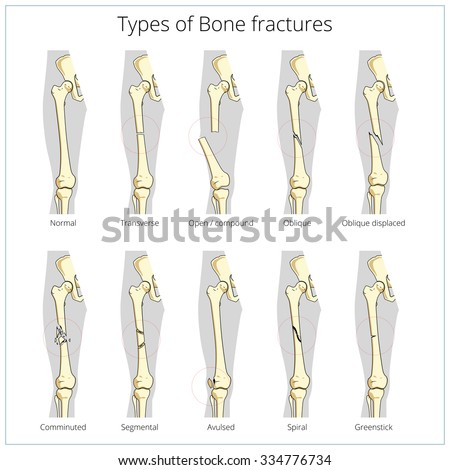 Types Bone Fractures Medical Skeleton Anatomy Stock Illustration ...