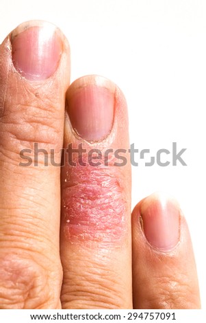 Rash Stock Photos, Images, & Pictures | Shutterstock