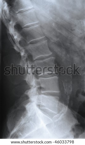 L5 S1 Lumbar Spot Xray Stock Photo 3679996 - Shutterstock