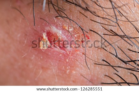 pictures of pimple on human skin macro csp9188528 search stock photos images skin boils stock images royalty free images vectors pictures of pimple on human skin macro csp9188528 search stock photos images skin boils stock images royalty free images vectors