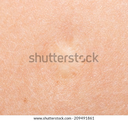 scar on human skin stock photo 209491861 scar tissue stock images royalty free images vectors scar on human skin stock photo 209491861 scar tissue stock images royalty free images vectors