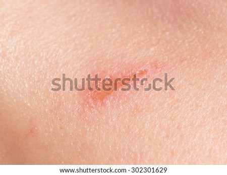 scar on human skin stock photo 209491861 scar on human skin stock photo 209491861 scar on human skin stock photo 209491861 scar on human skin stock photo 209491861