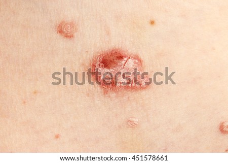 scar on human skin stock photo 97015703 scar on human skin stock photo 209040517 scar on human skin stock photo 97015703 scar on human skin stock photo 209040517