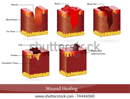 Wound Healing Illustration Showing Skin After Stock Vector 74446063