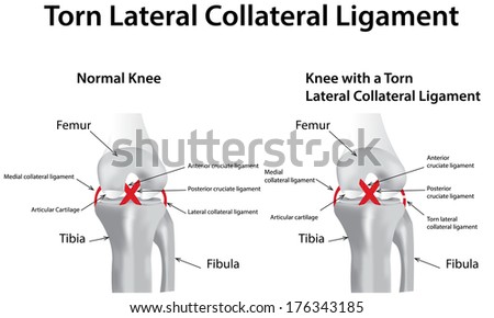 Torn Lateral Collateral Ligament - stock photo