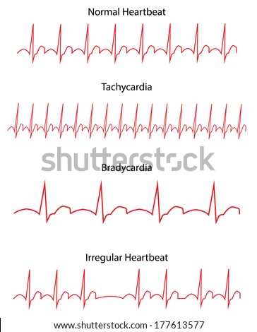 Ecg Pathology Trace Stock Vector 177613577 - Shutterstock