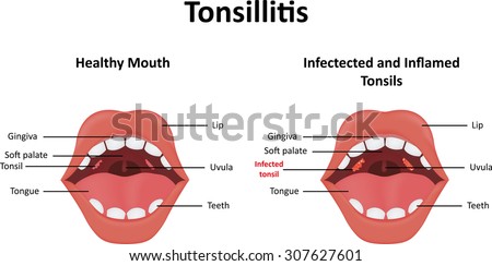 Tonsils Stock Photos, Images, & Pictures | Shutterstock