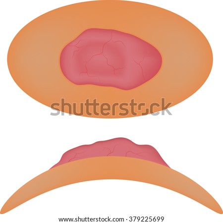 Basal Cell Carcinoma Stock Images, Royalty-Free Images & Vectors ...