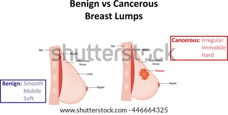 Benign breast lump what is it new porn