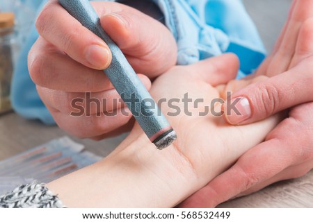 Alternative medicine therapist doing moxa treatment on her client