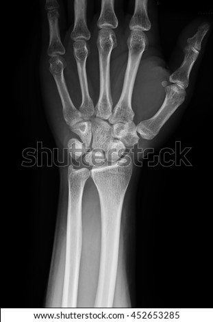 Xray Human Hand Wrist Stock Photo 62282380 - Shutterstock