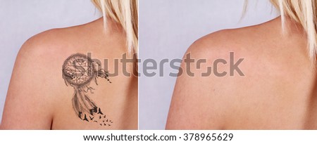 tattoo removal stock images royalty free images u0026 vectors tattoo removal stock images royalty free images u0026 vectors