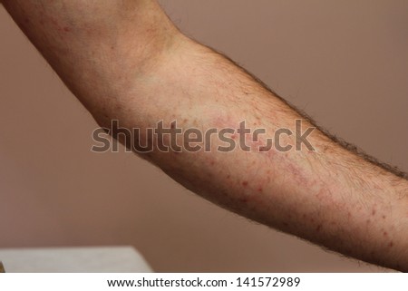 Typical Macular Rash Forearm This Could Stock Photo 24223534 - Shutterstock