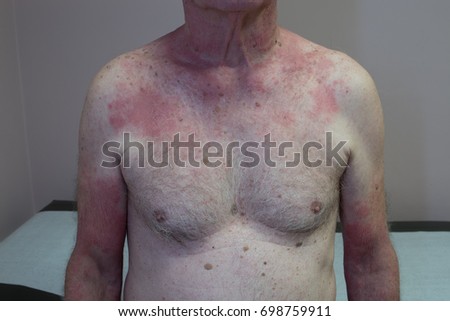 cipro poisoning symptoms ciprofloxacin eye drops for babies