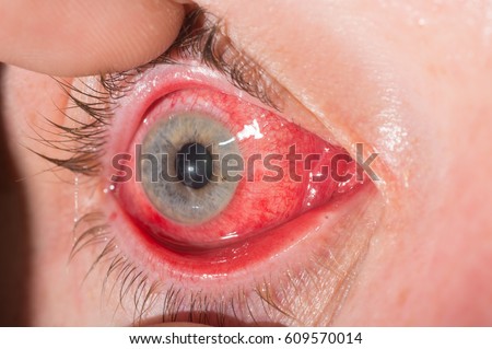 Close up of common eye infection and inflamnmation during eye examination.