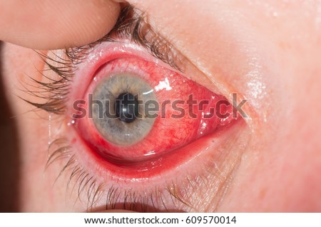Close-up de infecção ocular comum e inflamação durante o exame oftalmológico.