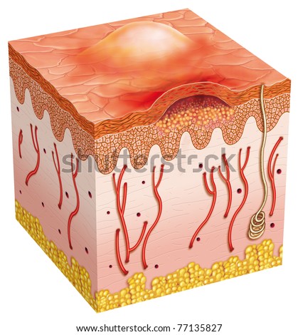 Skin Abrasion Stock Images, Royalty-Free Images & Vectors | Shutterstock