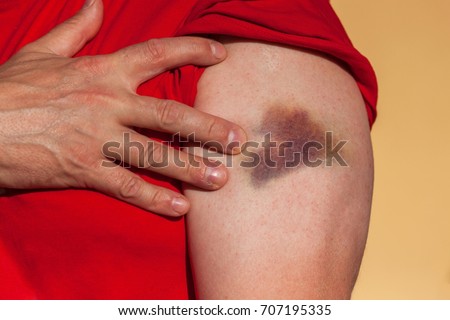 Bruised Arm Stock Images Royalty Free Images Amp Vectors Shutterstock