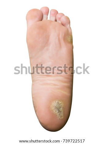 Major Foot Calluses On Heel Isolated Stock Photo 739722517 - Shutterstock