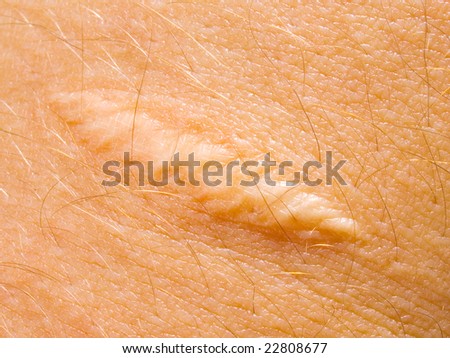 skin scar stock images royalty free images vectors skin scar stock images royalty free images vectors skin scar stock images royalty free images vectors skin scar stock images royalty free images vectors