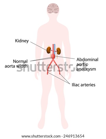 Abdominal Aortic Aneurysm Human Kidney Aorta Stock Vector ...