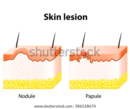 Papule Nodule Skin Lesion Stock Illustration 386528674 - Shutterstock