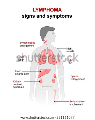 Lymphoma Cancer Disease Signs Symptoms Man Stock Illustration 531161077 ...