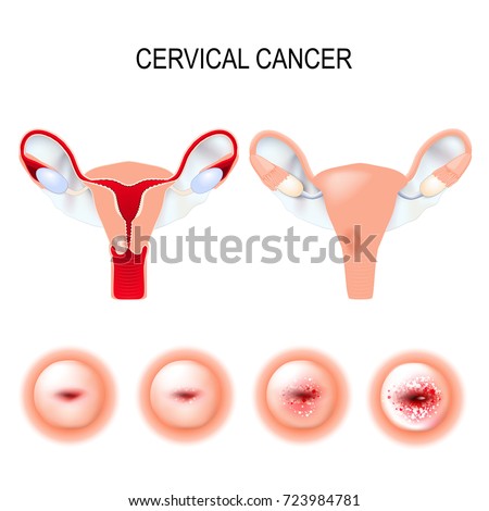 The Problem And Its Background Of Cervical