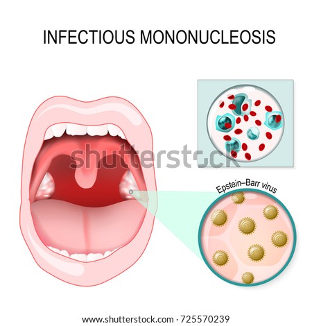 Mononucleosis Signs Symptoms Infectious Mononucleosis Human Stock ...