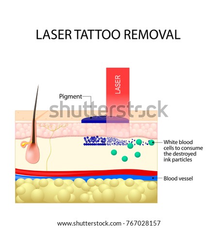 laser tattoo removal dark ink absorb stock vector 767028157 laser tattoo removal dark ink absorb stock vector 767028157