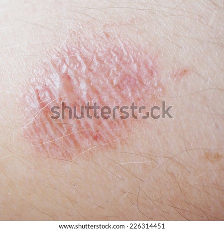 Skin Burn Stock Photos, Images, & Pictures | Shutterstock