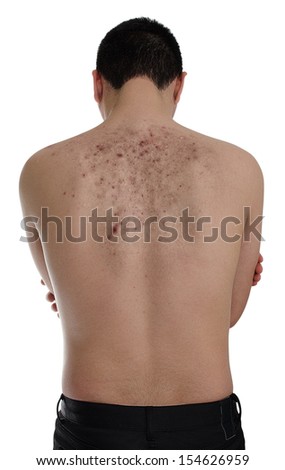 Scar Stock Photos, Images, & Pictures | Shutterstock