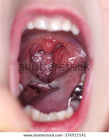 Map right Strep throat tonsil