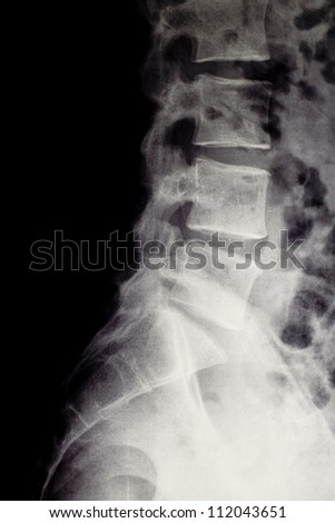 L5s1 Herniated Disc Reduced Intervertebral Space Stock Photo 112043651 ...