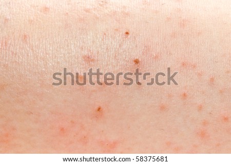 macro eczema on grip skin stock photo 7891171 macro eczema on grip skin stock photo 7891171 macro eczema on grip skin stock photo 7891171 macro eczema on grip skin stock photo 7891171