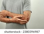 Small photo of Anonymous person with monkeypox, monkey pox epidemic concept