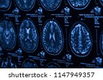 the x ray of the human brain... | Shutterstock . vector #1147949357
