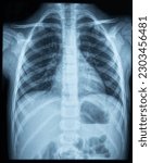 X ray photo image of chest area ...