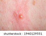 Small photo of ripe pimple on the inflamed reddened skin of a person close-up, problem dry skin with an inflammatory rash.