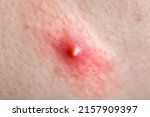 Small photo of acne on inflamed human skin, teen body health and problems of red pimple close-up texture of human skin.