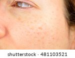 closeup of a woman cheek with liver spot causes by the large exposition sun 