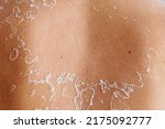 Small photo of Shedding skin after sunburn on back. Reminiscent of map, background of human skin with dry peeling skin. texture of irritated skin with cracks from dead cells, redness after sunburn, allergy on human