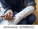 Small photo of Fun creative fun to draw on plaster cast on broken arm. teenage girl with broken arm with cast draws pictures with marker on cast