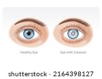 Human Healthy Eye And Eye With...