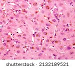 Small photo of Human liver. Cholestasis. This micrograph shows brown deposits of bile located mostly in Kupffer cells due to regurgitation of bile into the sinusoidal spaces.
